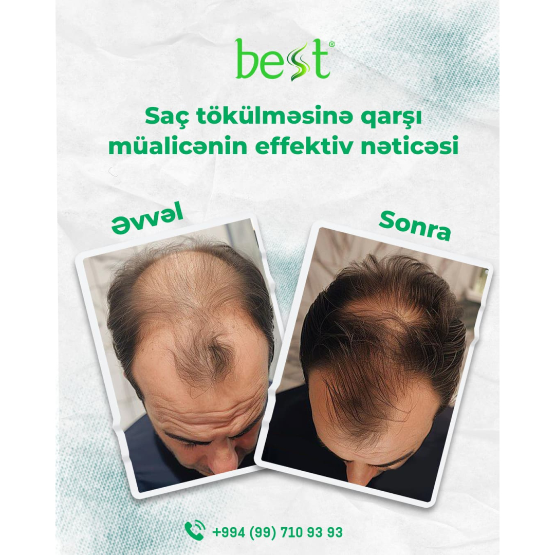 Saç tökülməsinə qarşı məhsullar, Best