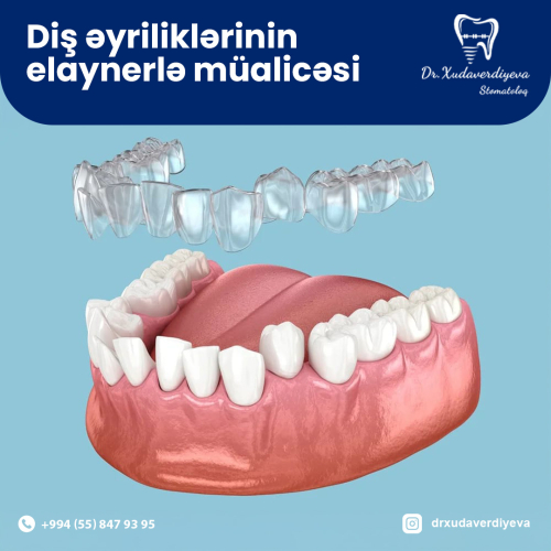 Diş əyriliyi müalicəsi, Tovuz Xudaverdiyeva