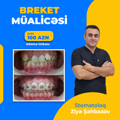 Breket müalicesi, Ziya Şahbazov