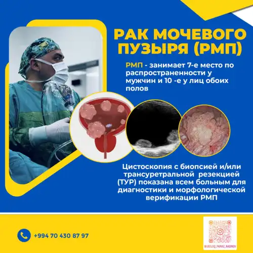 Sidik kisəsi xərçəngi müalicəsi, Pərviz Nəsirov